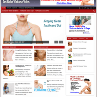 varicose veins